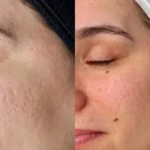 Microneedling with PRP in Calgary | Real Skin Rejuvenation