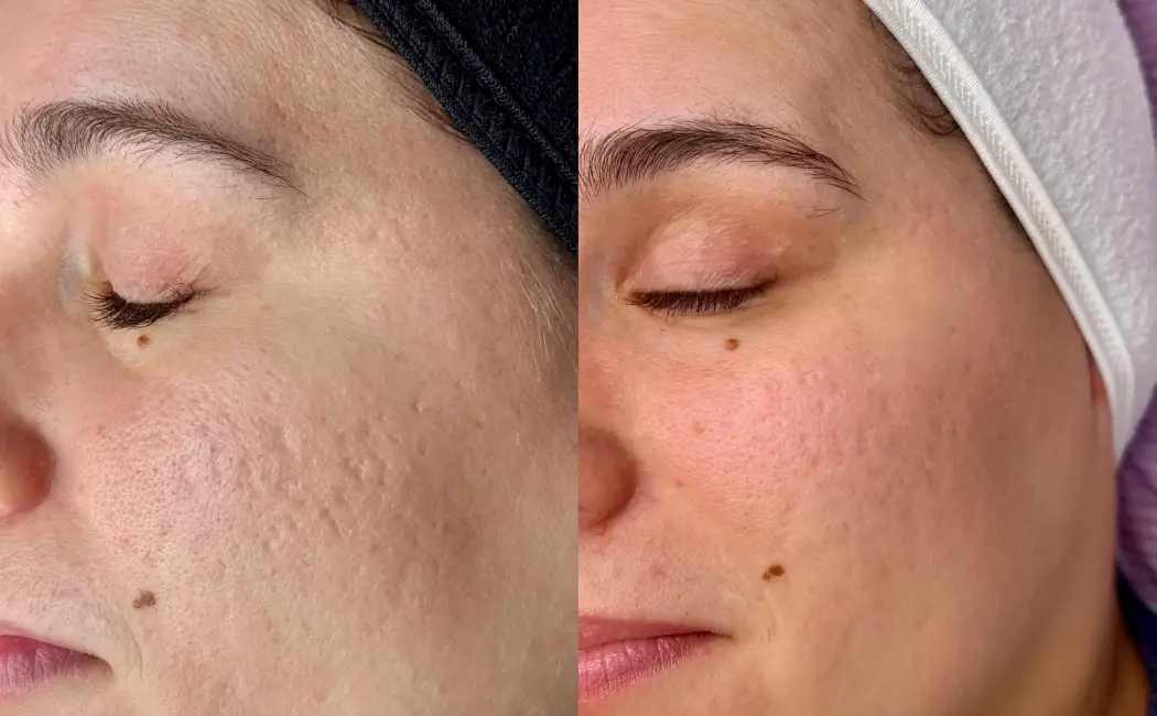 Microneedling with PRP in Calgary | Real Skin Rejuvenation