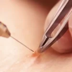Skin Tag Removal Calgary | Safe, Fast & Professional