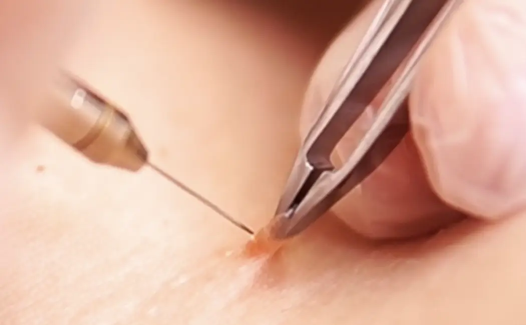 Skin Tag Removal Calgary | Safe, Fast & Professional