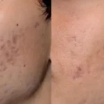 Pico Laser for Acne Scars in Calgary | Cost, Results, and Before & After Guide
