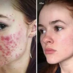 Accutane for Acne | The Complete Guide to Isotretinoin Treatment, Results and Side Effects