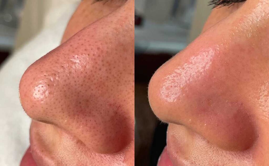 Why Everyone in Calgary is Searching for HydraFacial Near Me