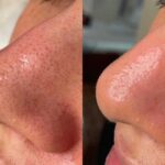 Why Everyone in Calgary is Searching for HydraFacial Near Me